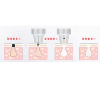 Succionador Puntos Negros, Quita Espinillas, Granos, Limpiador de Poros